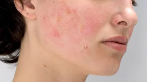 acne-prone-skin