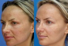 Laser Skin Tightening in New Jersey: The Advantages of Erbium YAG Laser Therapy