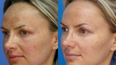 Laser Skin Tightening in New Jersey: The Advantages of Erbium YAG Laser Therapy