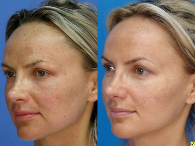 Laser Skin Tightening in New Jersey: The Advantages of Erbium YAG Laser Therapy