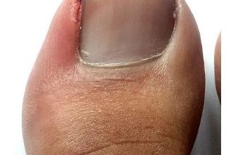 How To Drain Pus From Ingrown Toenail