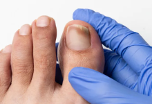 How to Heal a Toe Infection and Prevent Future Infections