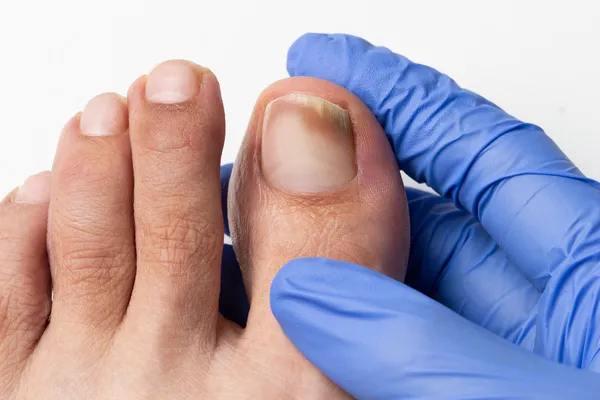 How to Heal a Toe Infection and Prevent Future Infections