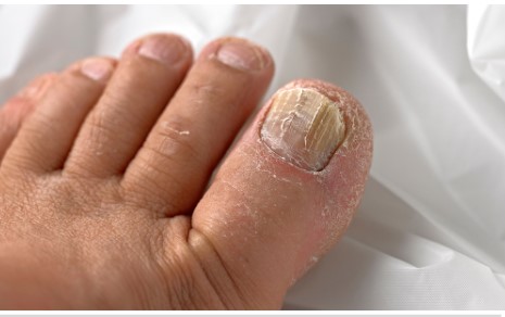 What Home Remedies Work for Pus Under the Toenail