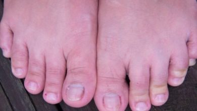 What Is The Significance Of Triple Arthrodesis In Foot And Ankle Surgery