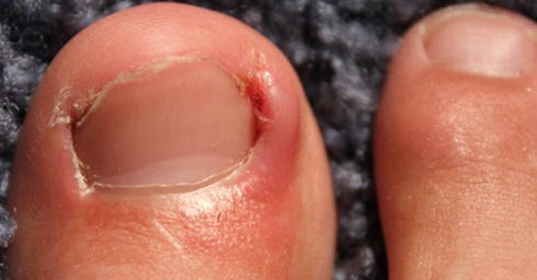 What to Do If Your Ingrown Toenail Leaking Pus