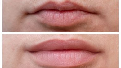 What to Expect from Botox Lips Treatment