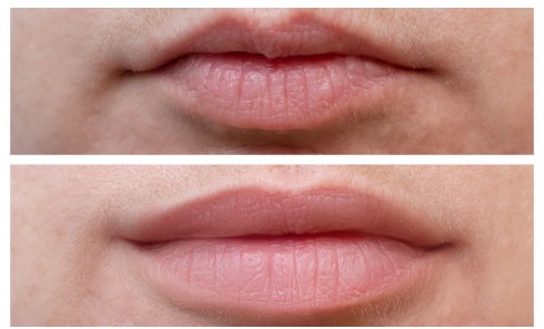 What to Expect from Botox Lips Treatment