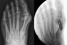 Where Can I Find Minimally Invasive Bunion Surgery Near Me