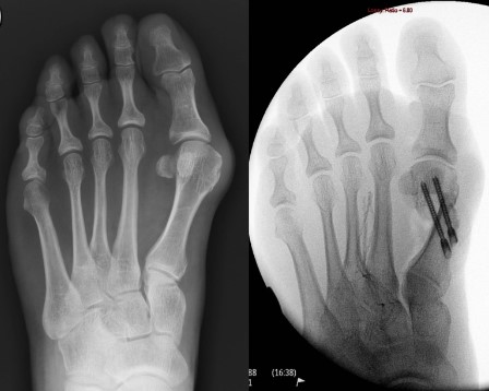 Where Can I Find Minimally Invasive Bunion Surgery Near Me