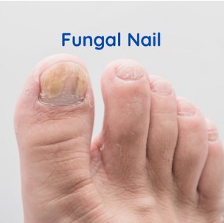 Where to Find Effective Solutions for Toe Nail Fungus