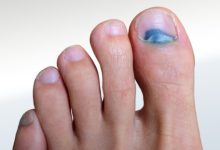 Where to Find Effective Treatment Solutions for Toenail Injuries