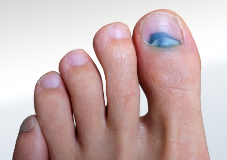 Where to Find Effective Treatment Solutions for Toenail Injuries