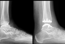 Where to Find Expert Care for Total Ankle Replacement in Scottsdale