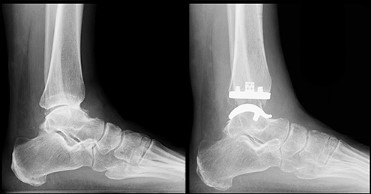 Where to Find Expert Care for Total Ankle Replacement in Scottsdale