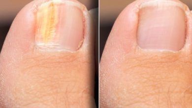 Where to Find Toenail Laser Treatment in Scottsdale