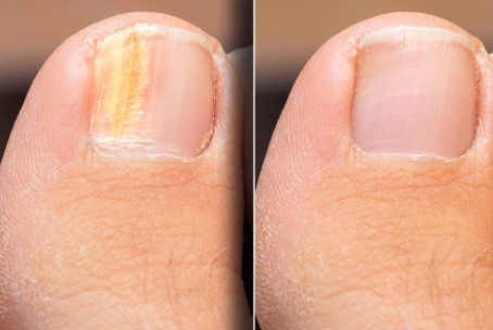 Where to Find Toenail Laser Treatment in Scottsdale