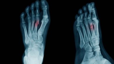 Where to Find the Best Bunion Surgery Near Me