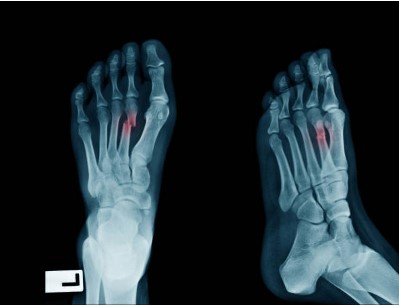 Where to Find the Best Bunion Surgery Near Me
