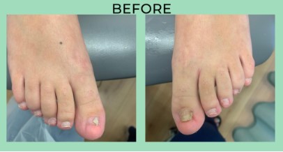 Where to Get Toenail Removal Surgery in Scottsdale
