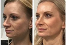 Where to Inquire About the Price of Sculptra in Torrance