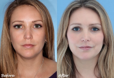 Why Choose Sculptra Injections For A Youthful Glow