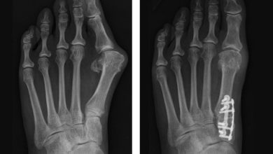 Why Is Minimally Invasive Bunion Surgery Preferred by Many