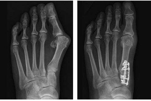Why Is Minimally Invasive Bunion Surgery Preferred by Many