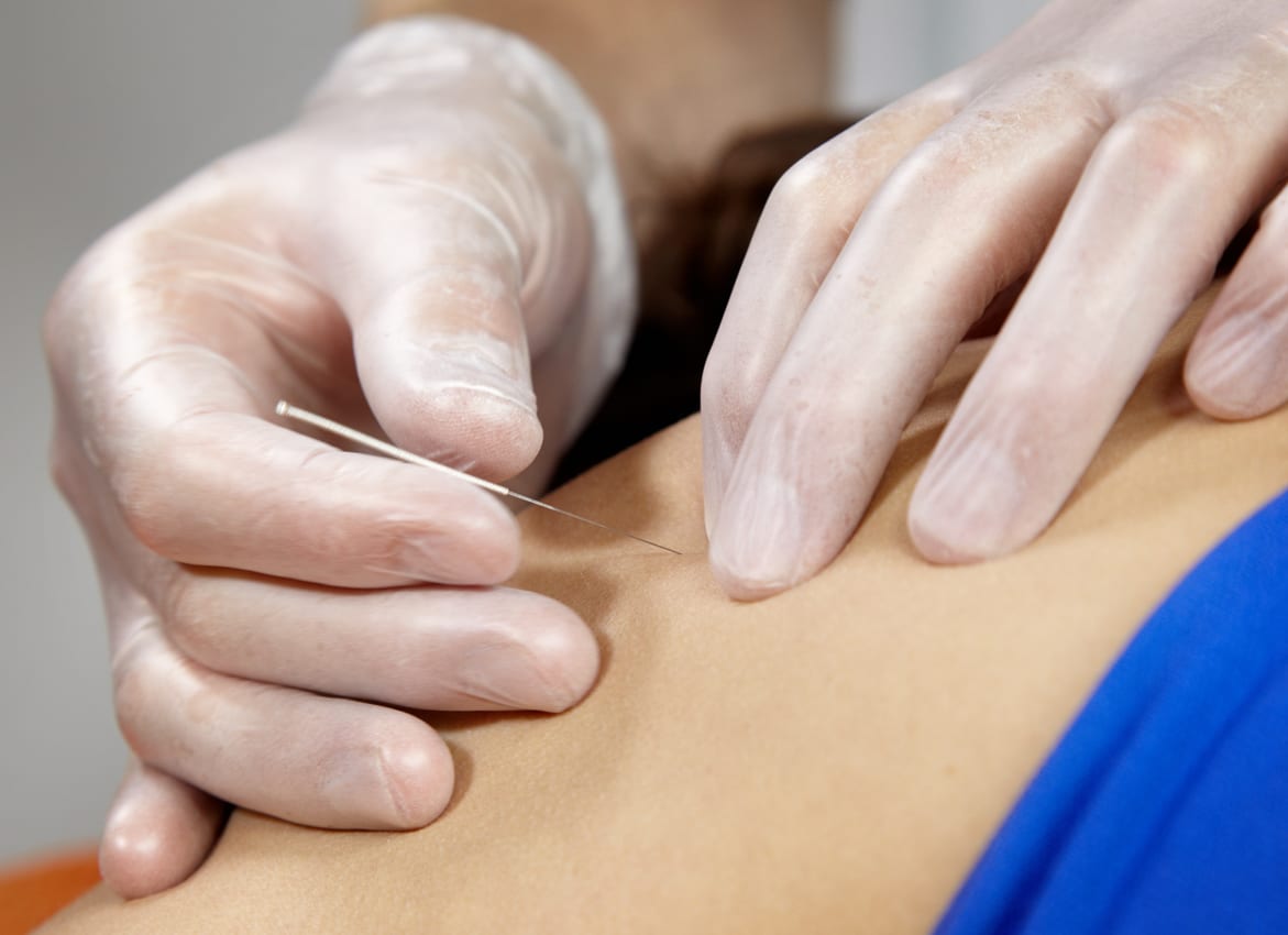 dry needling therapy clinic in Lahore